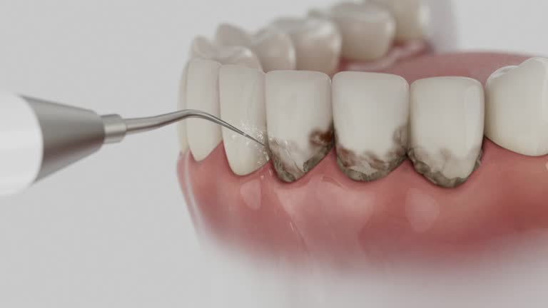 Trusted Dental Crowns And Bridges service in Danville, VA - Dentist Open Now